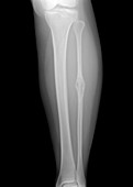 Bone cancer,X-ray