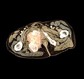 Bone cancer,MRI scan