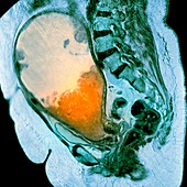 Cancer of the uterus,MRI scan