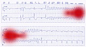 ECG trace of a heart attack