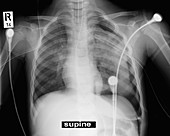 Bronchus lung injury,X-ray