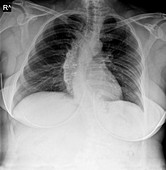 Pulmonary oedema,X-ray