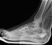 Osteoarthritis of the foot,X-ray