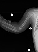 Arm of child abuse victim,X-ray