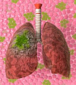 Lung cancer,artwork