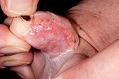 Infected athlete's foot