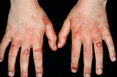 Streptococcal rash on the hands