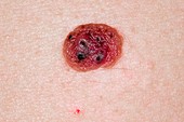 Intradermal mole (naevus) on the skin