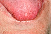 Fibroma on the tongue
