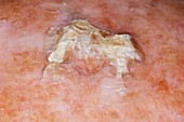 Squamous cell cancer on the scalp
