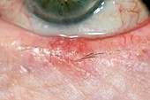 Inflamed chalazion on the eyelid