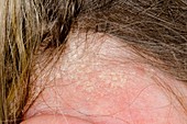 Psoriasis of the scalp