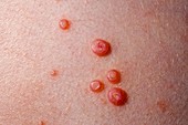 Molluscum contagiosum skin nodules