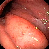 MALT lymphoma,endoscope view