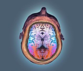 Normal brain,3D CT angiogram