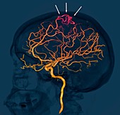 Brain vascular abnormality,3D CT scan