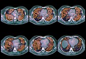 Interstitial lung disease,CT scan