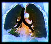 Kaposi's sarcoma of the lung,CT scan