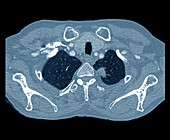 Lung cancer,CT scan