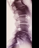 Scheuermann's disease,X-ray