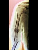 Fractures and bone cancer,X-ray