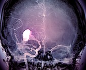 Brain haemorrhage,X-ray