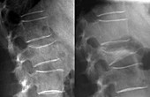 Spine fracture in osteoporosis,X-ray