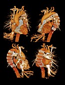 Aortic stent graft,3D CT scan