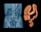 Healthy large intestine,X-ray & CT scan