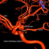 Brain aneurysm,3D X-ray