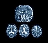 Marchiafava-Bignami in alcoholism,MRI