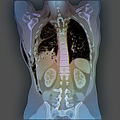 Haemopneumothorax,CT scan
