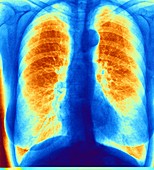 Normal chest,coloured x-ray