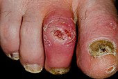 Infected toe ulcer