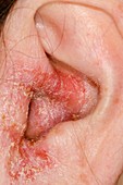 Infected outer ear