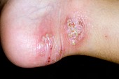 Infected eczema on the foot