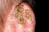 Seborrhoeic eczema on the ear