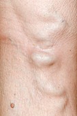 Varicose veins