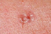 Basal cell skin cancer on forehead