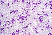 Acute myeloid leukaemia,micrograph