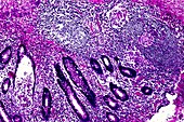 Crohn's disease,light micrograph
