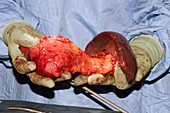 Pancreatectomy and splenectomy surgery