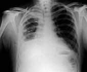 Drained pleural effusion,X-ray