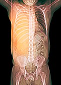 Pleural effusion in mesothelioma,X-ray