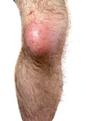 Bursitis of the knee