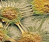Vaginal cancer cells,SEM