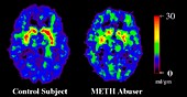 Brain damage due to drugs,PET scans