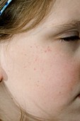 Petechial rash on young girl's face