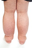 Lymphoedema in the legs