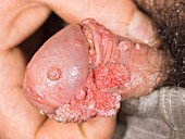 Genital warts on the penis